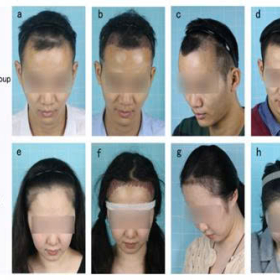 Hiệu quả của liệu pháp oxy cao áp kết hợp với phẫu thuật cấy tóc trong điều trị rụng tóc.